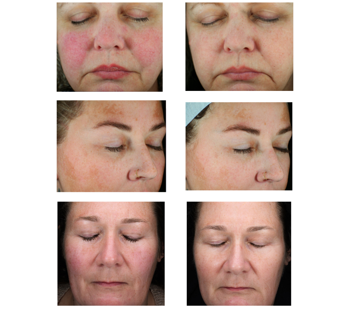 Glacial® Rx Before & After Results